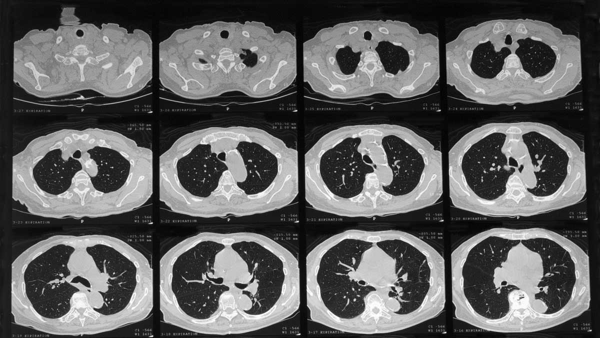 bilde av en HRCT-scanning tatt p&aring; datamaskinen hvor man ser sm&aring; tverrsnitt av brystkassen til en pasient